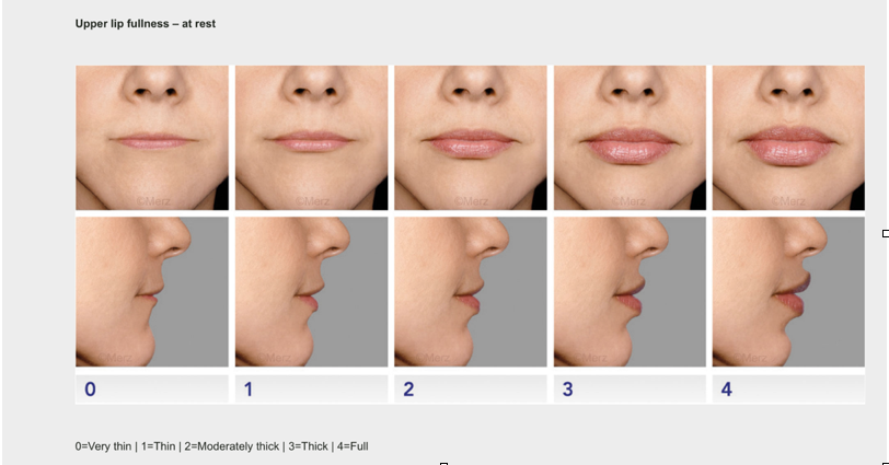 Merz-Aesthetic-Lip-Scale-lip-filler-chart