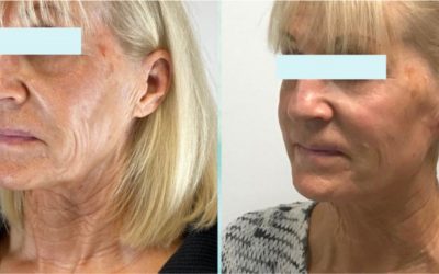 Case Study: Natural, Subtle Restoration of the Facial Profile and the Neck using Dermal Fillers and Profhilo®